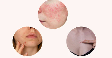 Rode vlekjes in het gezicht? Zo kom je ervan af!